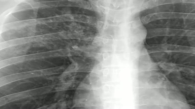 放大人体胸部结核病 (TB) 筛查的x射线图像。