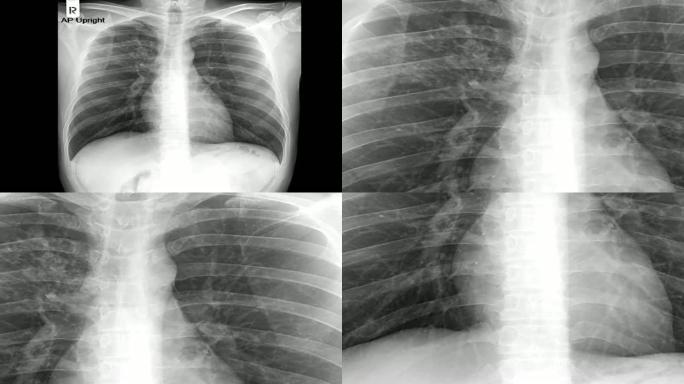 放大人体胸部结核病 (TB) 筛查的x射线图像。