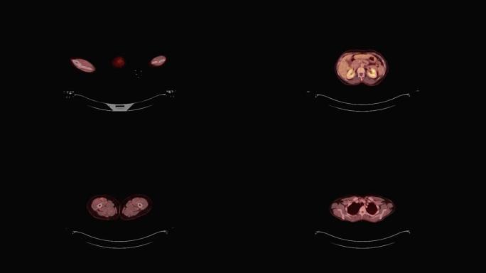 计算机断层扫描 (PET/CT) 的全身轴向视图。