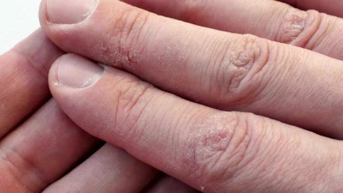 皮肤干裂的手指。有皮肤病学问题的手。