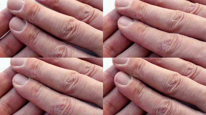 皮肤干裂的手指。有皮肤病学问题的手。