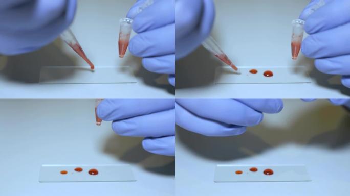 实验室技术人员拿着移液器，在医院病房中测试血液样本是否输血，双手合十。医生拿着血液试管的特写。艾滋病