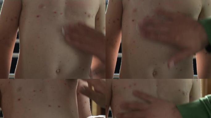 水痘/皮疹2