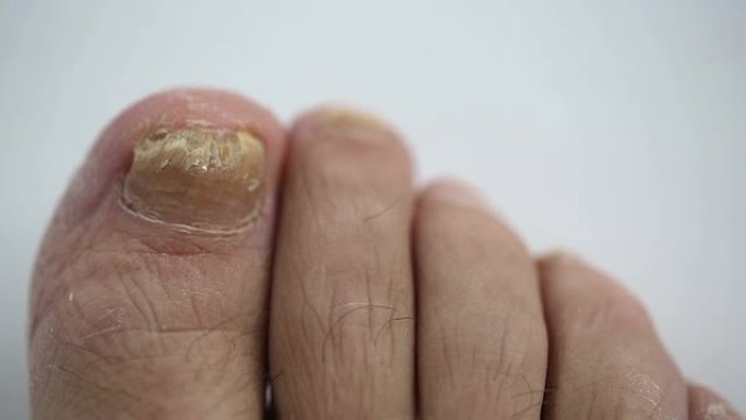 脚趾甲感染真菌