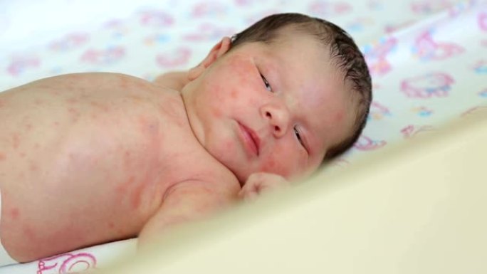 在医院的床上躺着皮肤过敏的新生婴儿的特写镜头。