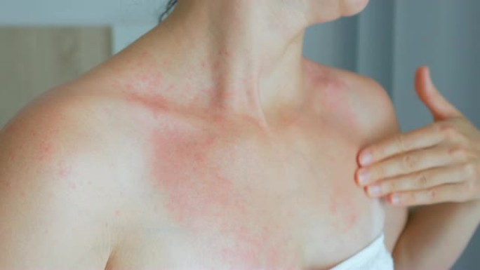 女人用手、脖子抓痒。脖子上有红斑，过敏，牛皮癣，昆虫叮咬。疟疾。晒伤。晒伤