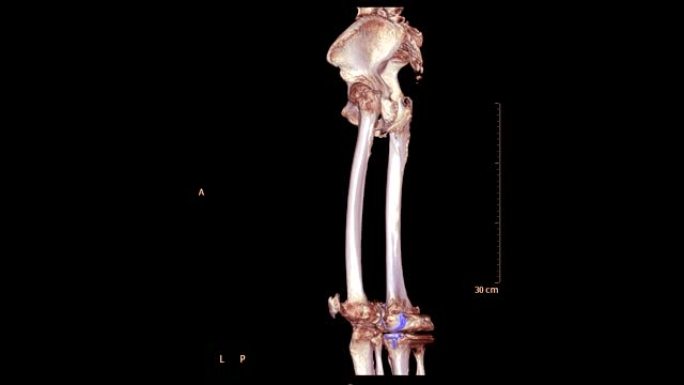 骨盆骨的ct扫描包括两个股骨3d渲染图像的屏幕周围。