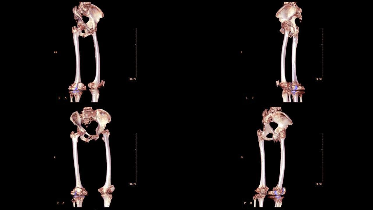 骨盆骨的ct扫描包括两个股骨3d渲染图像的屏幕周围。