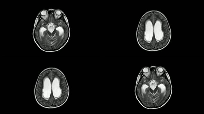 MRI脑鞍上肿块对视交叉、垂体、第三脑室、下丘脑造成肿块效应。