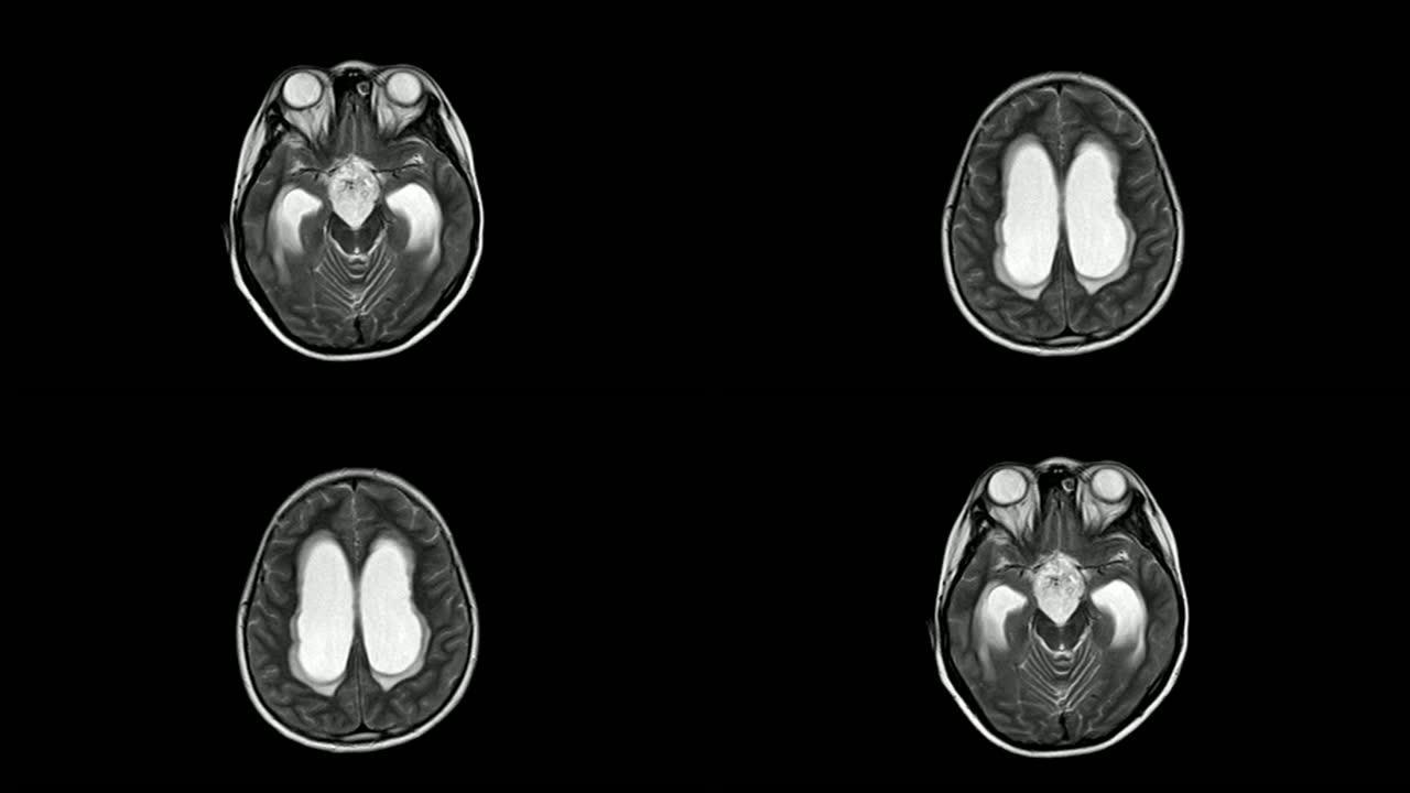 MRI脑鞍上肿块对视交叉、垂体、第三脑室、下丘脑造成肿块效应。