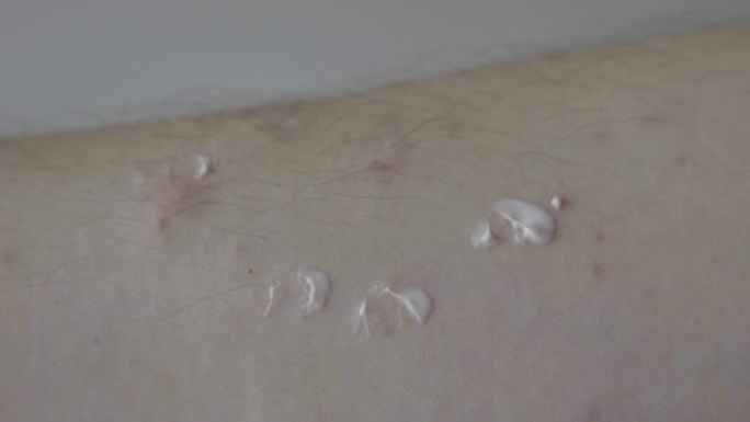 患有皮肤病症状的年轻人在他受刺激的手臂上使用抗过敏润肤霜
