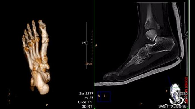 CT足或扫描两脚3D渲染图像比较3D图像和2D矢状面视图显示胫骨远端骨折。