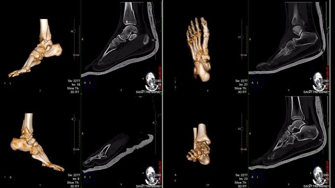 CT足或扫描两脚3D渲染图像比较3D图像和2D矢状面视图显示胫骨远端骨折。