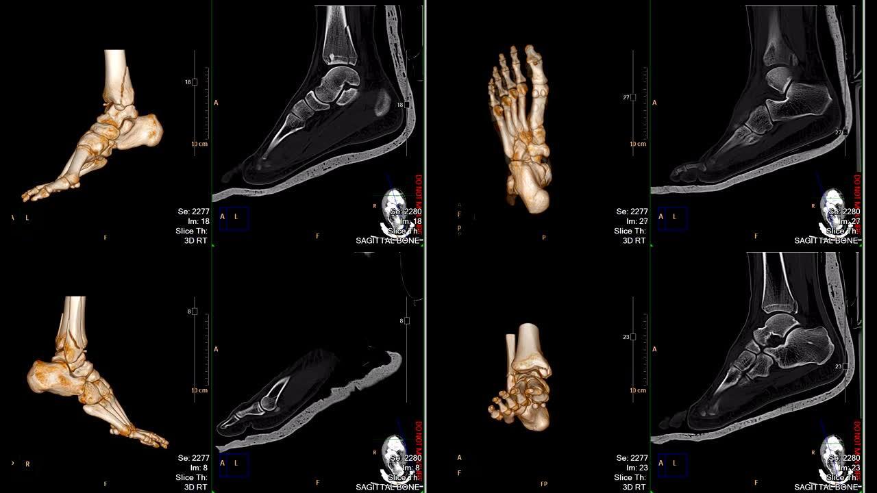 CT足或扫描两脚3D渲染图像比较3D图像和2D矢状面视图显示胫骨远端骨折。