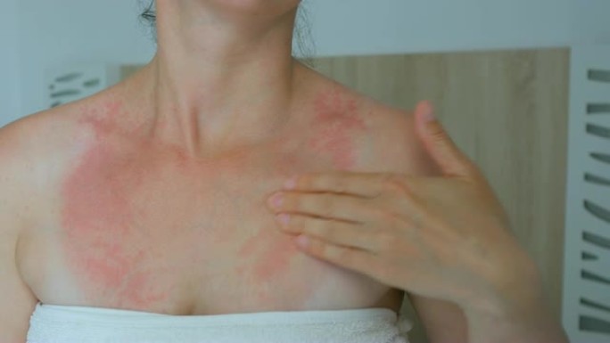 女人用手、脖子抓痒。脖子上有红斑，过敏，牛皮癣，昆虫叮咬。疟疾。晒伤。晒伤