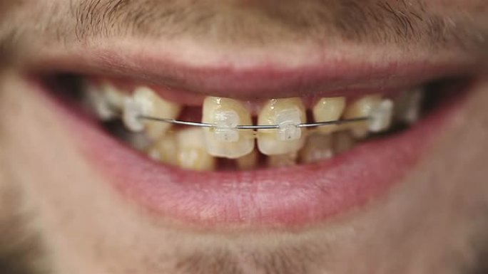 一个男人在牙齿上露出牙套的特写镜头