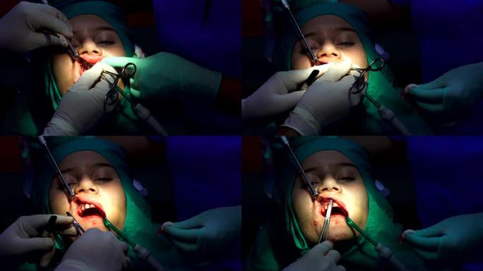 口腔手术，用手术针缝合伤口