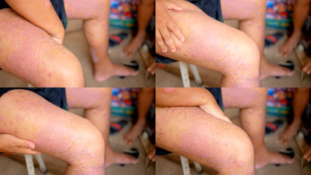 牛皮癣患者使用草药使用自己的腿部伤口