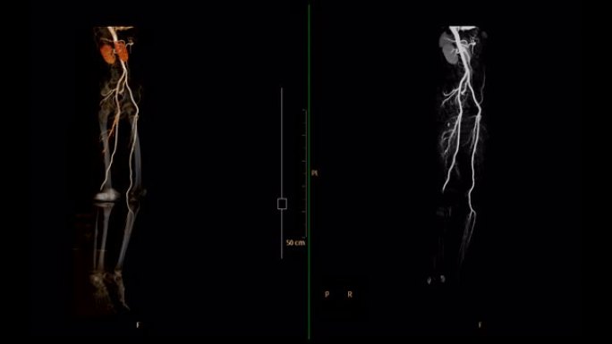 CTA股动脉偏离3D渲染图像vs MIP成像显示下肢所有血管。股动脉CT血管造影。