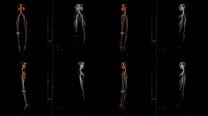 CTA股动脉偏离3D渲染图像vs MIP成像显示下肢所有血管。股动脉CT血管造影。