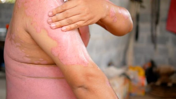 牛皮癣患者使用草药治疗手臂的伤口。