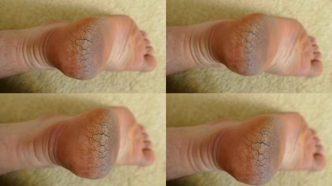 裂纹人类脚跟，皮肤病和裂纹脚跟，4k视频，