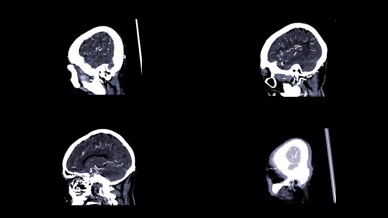 计算机断层扫描血管造影，CTA脑3D渲染图像在矢状面从左到右显示脑血管。