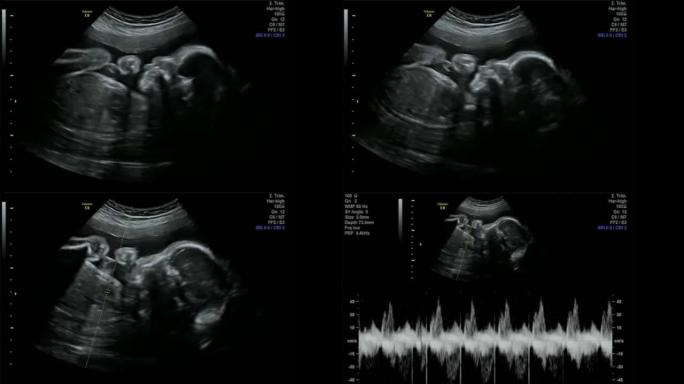 令人难以置信的婴儿心率声-超声扫描妊娠3d和4d超声检查妊娠胎儿检查人类胚胎胎儿回声描记术26周妊娠