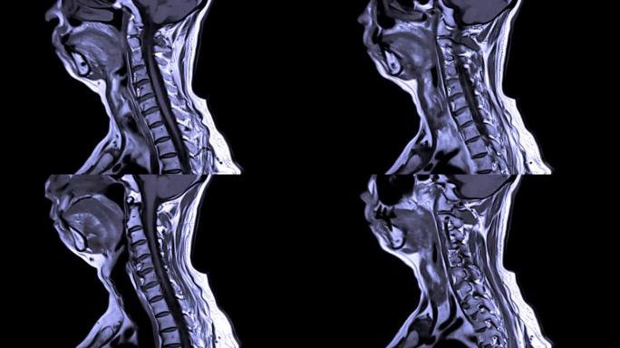 颈椎MRI或c-脊柱侧视。
