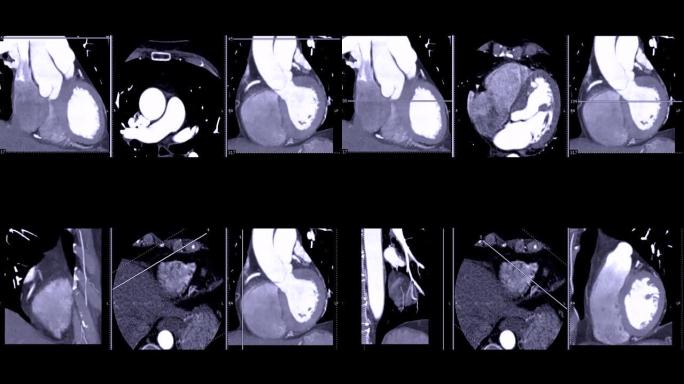 冠状动脉或CTA冠状动脉的CT血管造影。