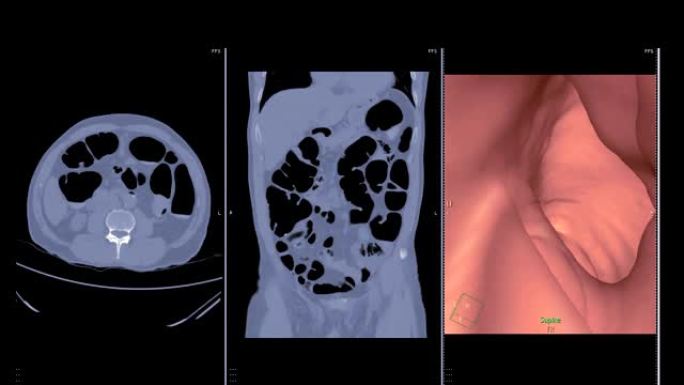 CT结肠造影病情医患互动显微镜分析