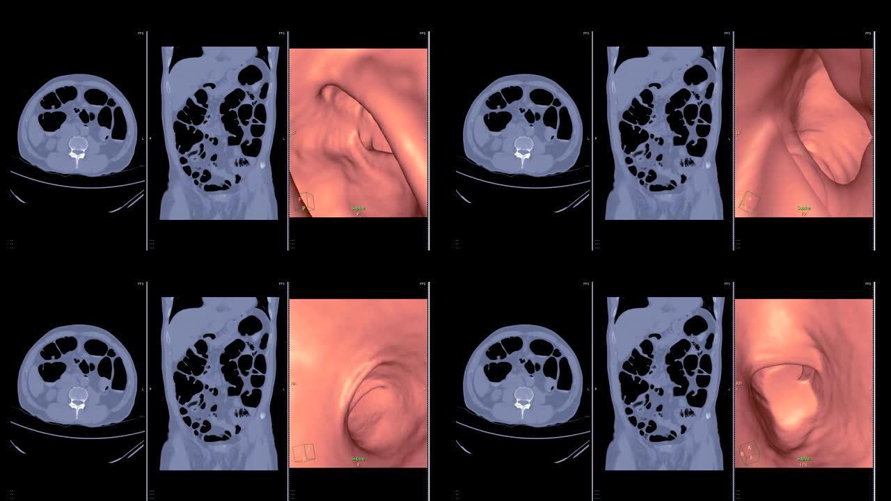 CT结肠造影病情医患互动显微镜分析