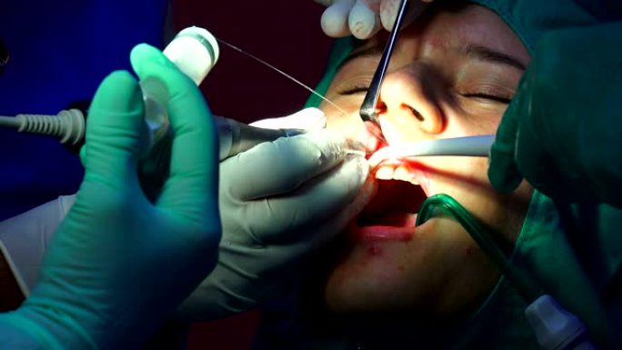 种植牙手术，apicectomia牙龈手术，特写