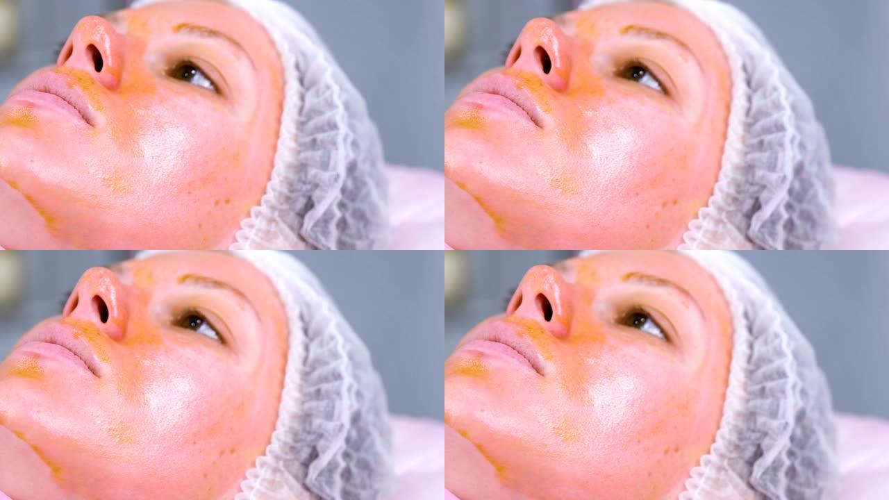女人脸上的化学剥皮。