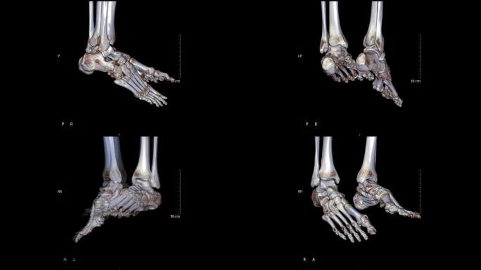 CT足或双足3D扫描在屏幕上旋转显示胫骨远端骨折的图像。