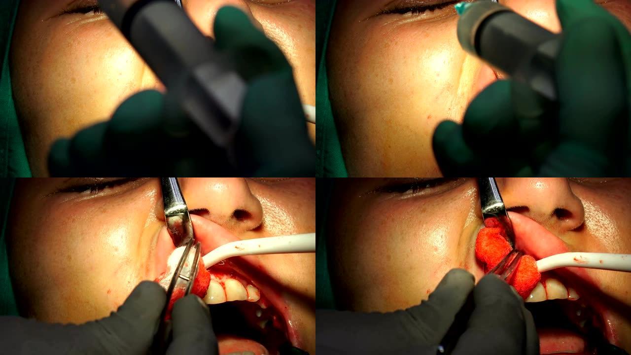 种植牙手术，apicectomia牙龈手术，特写