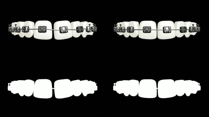 Breackets，矫正牙齿