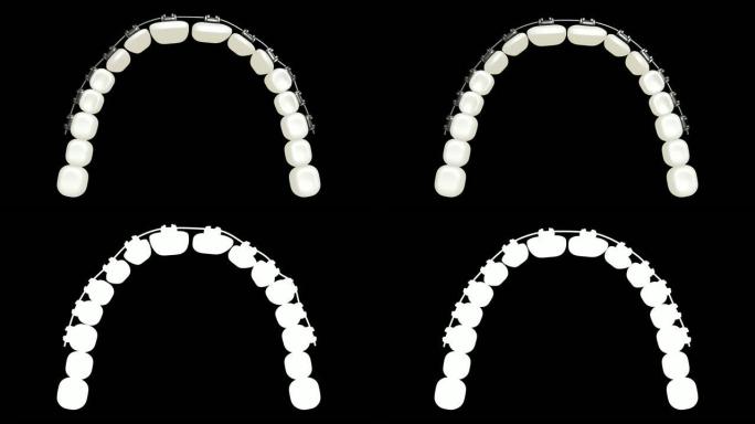 Breackets，矫正牙齿