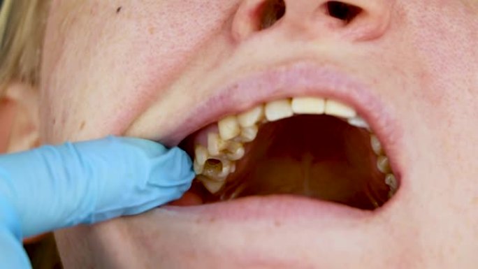 牙齿上的孔和牙管的治疗。牙科诊所牙周炎的治疗