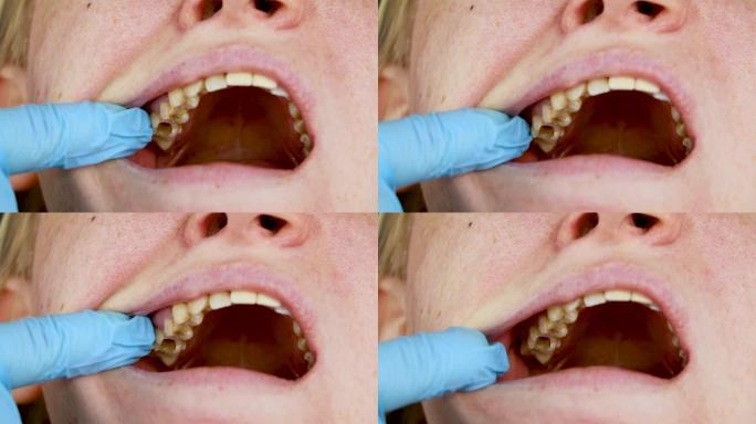 牙齿上的孔和牙管的治疗。牙科诊所牙周炎的治疗