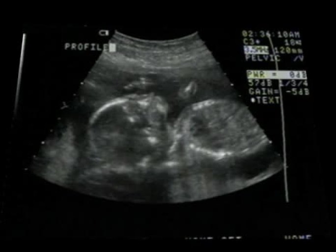 婴儿吮吸拇指超声波