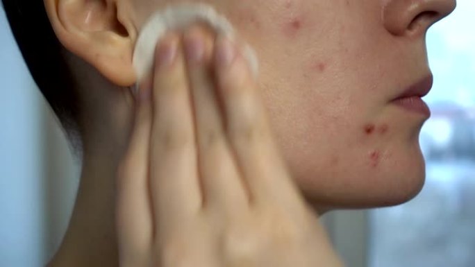 关闭皮肤问题 (不健康的皮肤痤疮和丘疹)。问题皮肤的治疗。