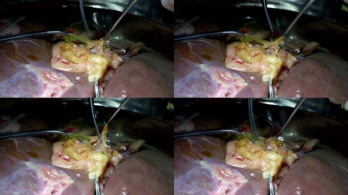 医生从人体肝脏中去除脂肪。
