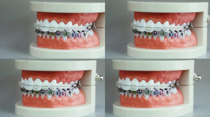 不同类型牙套的人类颌骨模型