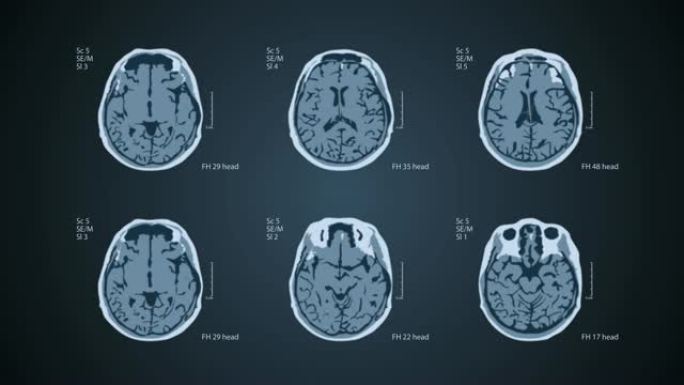 大脑MRT扫描。一个屏幕上有6个视图。4k医用蓝色背景