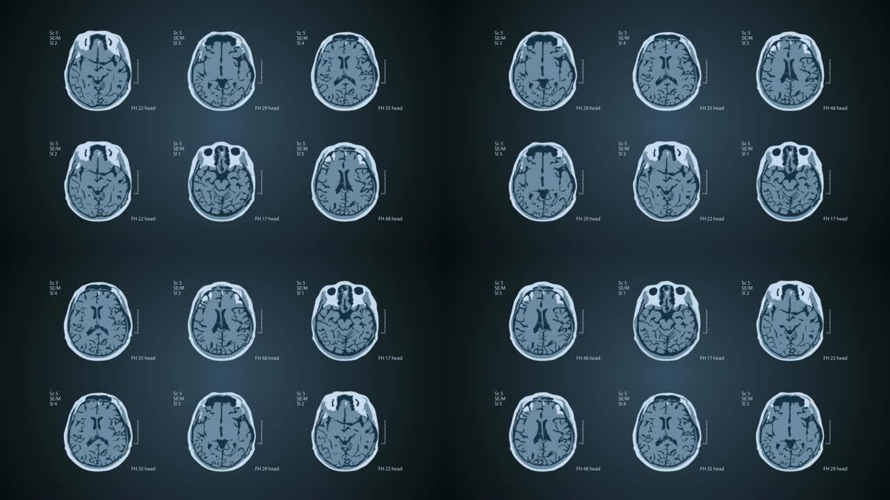 大脑MRT扫描。一个屏幕上有6个视图。4k医用蓝色背景