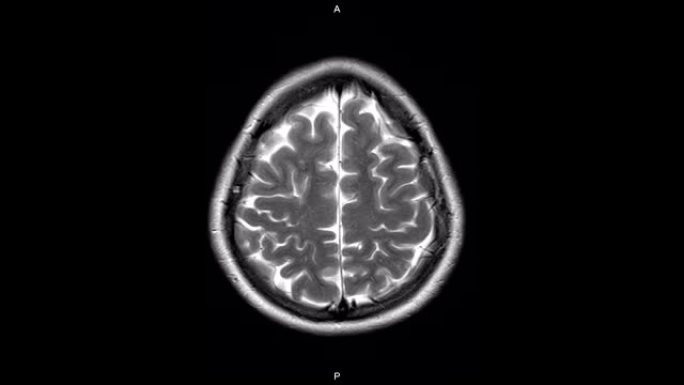 用钆造影剂对大脑进行轴向MRI。大脑的磁共振成像。