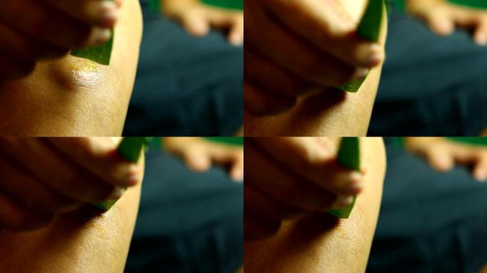 男子将芦荟涂抹在腿上