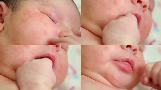 在医院的床上躺着皮肤过敏的新生婴儿的特写镜头。