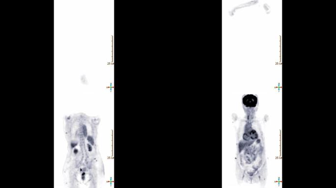 正电子发射断层扫描或PET ct扫描的整个人体3d渲染图像单色冠状视图。